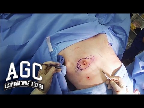 how to perform gynecomastia surgery