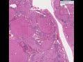 Histopathology Liver--Cirrhosis Histopathology Liver--Cirrhosis