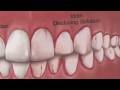 Dental Health & Gum Disease : How Is Plaque Detected?