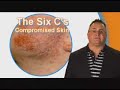 MRSA and Staph Infection Education MRSA and Staph Infection Education
