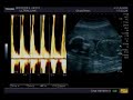 Ultrassom