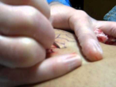 how to perform scarification