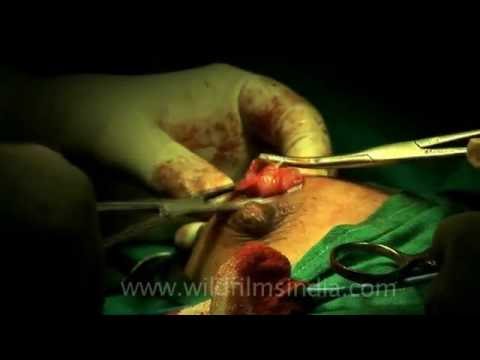 how to drain breast cyst