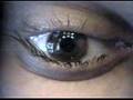 Bart's CustomVue Lasek Surgery at Park Avenue Laser Vison