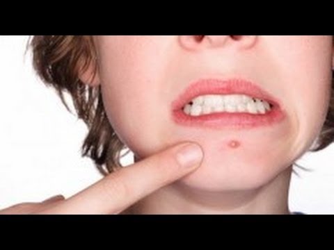 DermTV - Acne 101: Acne Causes [DermTV.com Epi #121]