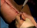 Iowa City Plastic Surgery Live: Arm Lift 3 of 14