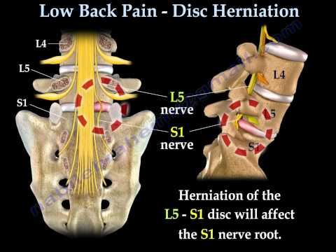 how to know slipped disc