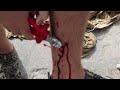 Angler hooked in leg