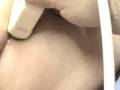 Vesícula Biliar- Acalculous cholecystopathy-Umbilical Hernia