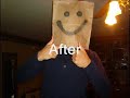 Acne Gone
