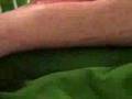 Wound Vac Change
