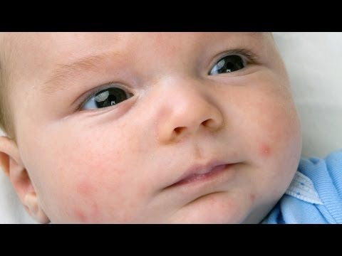 how to get rid of baby acne on a newborn