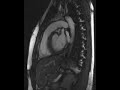 heart beat - MRI video of my beating heart (sagittal view) heart beat - MRI video of my beating heart (sagittal view)