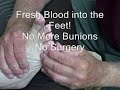 Bunion-Bunion Correction Demo