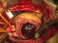 Removal of RA Myxoma on beating heart 1