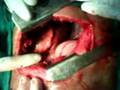 Open Chest Surgery