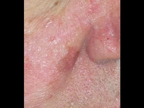 how to relieve dry nose