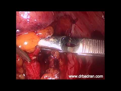 how to repair arteries