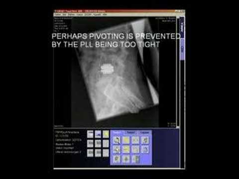 how to cure s'i joint pain