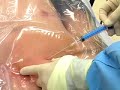 Central-Venous-Cathe