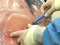 Central-Venous-Cathe