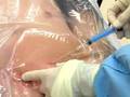 Central Venous Catheter  sample    www proceduresconsult com