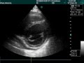 Ischemic Heart Disease In Echocardiography Exam