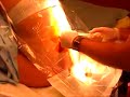 Epidural