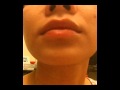 The Acne Practice  (Home Version 20)  -- Unbelievable Case