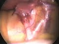 ureter identification ureter identification