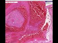 Histopathology Esophagus --Ruptured varices