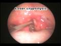 Tonsil stones and Halitosis