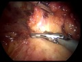Inguinal Lymphadenectomy (LEG Procedure) - Endoscopy Inguinal Lymphadenectomy (LEG Procedure) - Endoscopy
