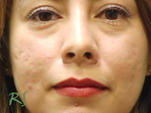 My Closed Rhinoplasty (Nose Job) Procedure to Remove a Hump in Beverly Hills