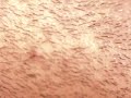 Ingrown hair wow! yuk! Ingrown hair wow! yuk!