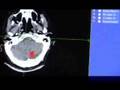 CyberKnife: Brain Tumor pt 1