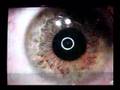 Jon's Eye Surgery