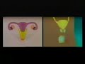 sexually transmitted disease  healthanthology com