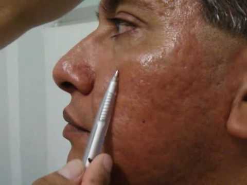 Atenuar cicatrices de acne, marcas de acne ¿Es Posible? - Tratamiento de acne en Lima