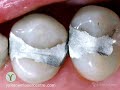 Replace Metal & Mercury Filings w/ Yaletown Laser Centre
