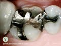 Replace Metal & Mercury Filings w/ Yaletown Laser Centre