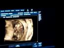 3D ultrasound at 12 weeks (1)