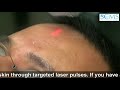 Acne Scar Treatment