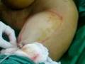 Liposuction of Arm by Vaser Liposelection Tech -Dr.Hasan Ali