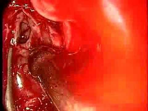 The Frontal Sinus Trephination Procedure