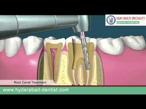 how to relieve root canal pain