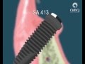 IMPLANTES DENTÁRIOS VIDEO DESDE A FASE CIRURGICA ATÉ A PROTÉTICA
