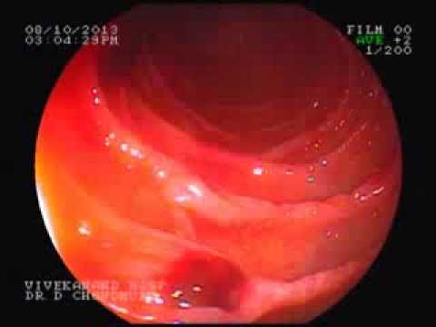 how to stop a g i bleed