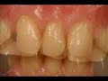 Dentures