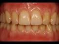Dentures